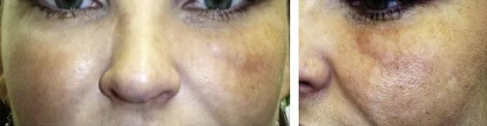 Mejilla izquierda con eritema e induración difusa mal delimitada cuatro semanas después de una inyección de relleno, en visión frontal y oblicua. No hay fluctuación, no hay puerta de entrada y el cultivo de estas lesiones suele ser negativo: es el aspecto real de una biopelícula reactivada, y por eso se parece más a una dermatitis que a un absceso. Advances in Cosmetic Surgery 2018, figura 4.
